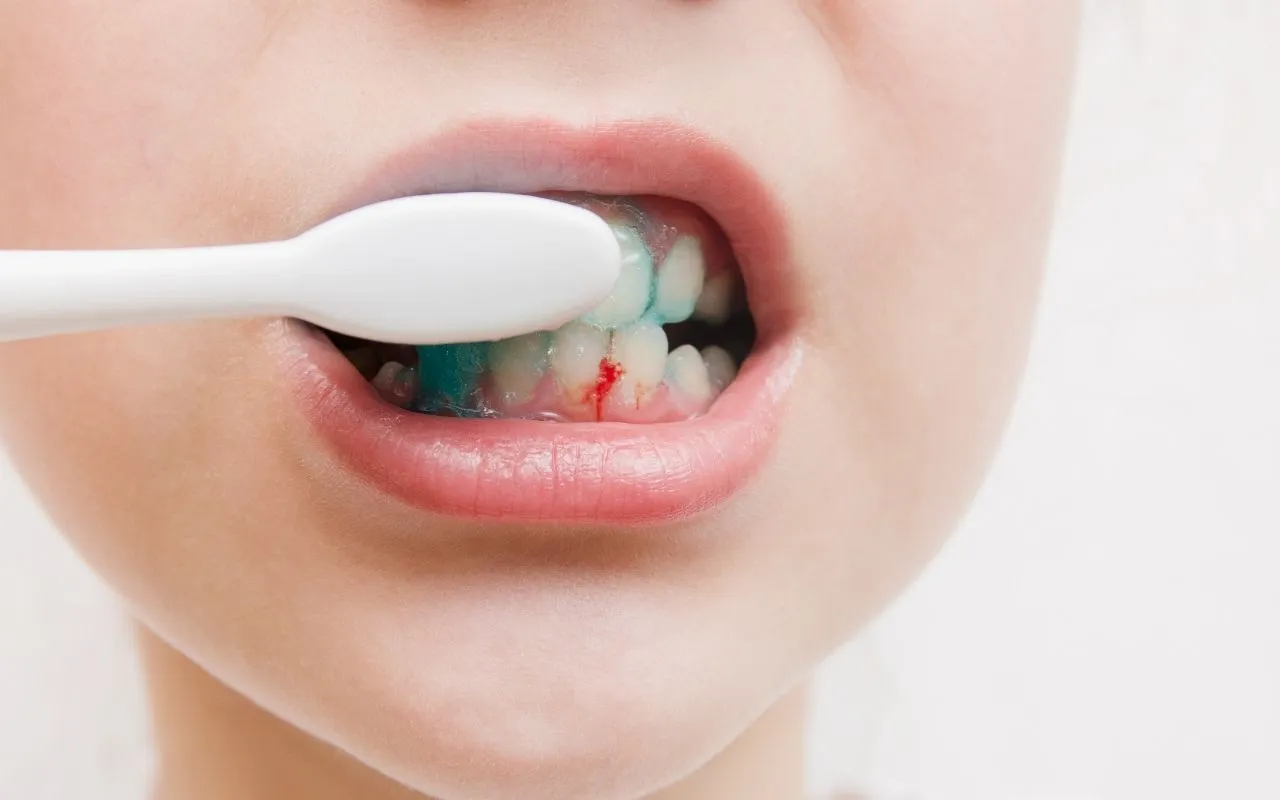 How to Prevent and Treat Bleeding Gums During Brushing Prevent and Treat Bleeding Gums